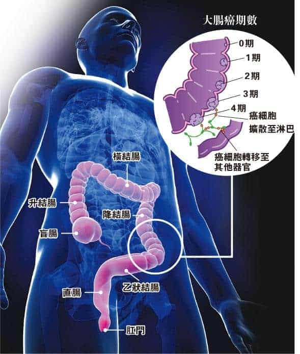 【大腸癌】排便習慣改變響警號 癌症期數0至4期治療、存活率有不同