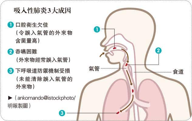 吸入性肺炎3成因 中風、認知障礙症患者倘「落錯格」細菌易入肺 注意口腔護理