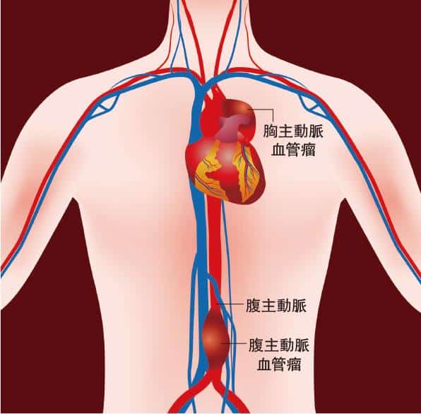 血管瘤破裂可致急性內出血 腹主動脈血管瘤最普遍 初無病徵 瘤大至5厘米腹背痛