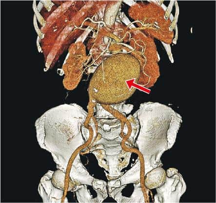 血管瘤破裂可致急性內出血 腹主動脈血管瘤最普遍 初無病徵 瘤大至5厘米腹背痛