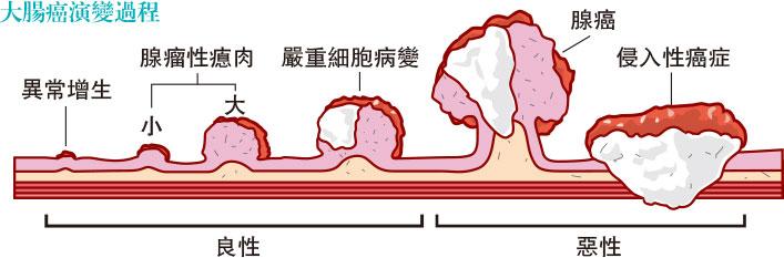 【大腸癌篩查】3大方法比併：大便隱血測試、驗糞便血液+基因、M3檢測驗細菌 高風險人士應定期照大腸鏡？