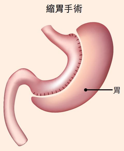 減肥失敗或因荷爾蒙問題治療糖胖症代謝手術：縮胃、胃繞道手術知多啲