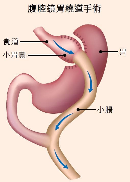 減肥失敗或因荷爾蒙問題治療糖胖症代謝手術：縮胃、胃繞道手術知多啲