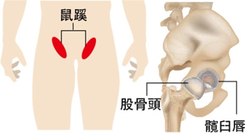 髖關節痛3大高危族 或髖臼韌帶撕裂影響活動幅度、咔咔聲 5招減壓力