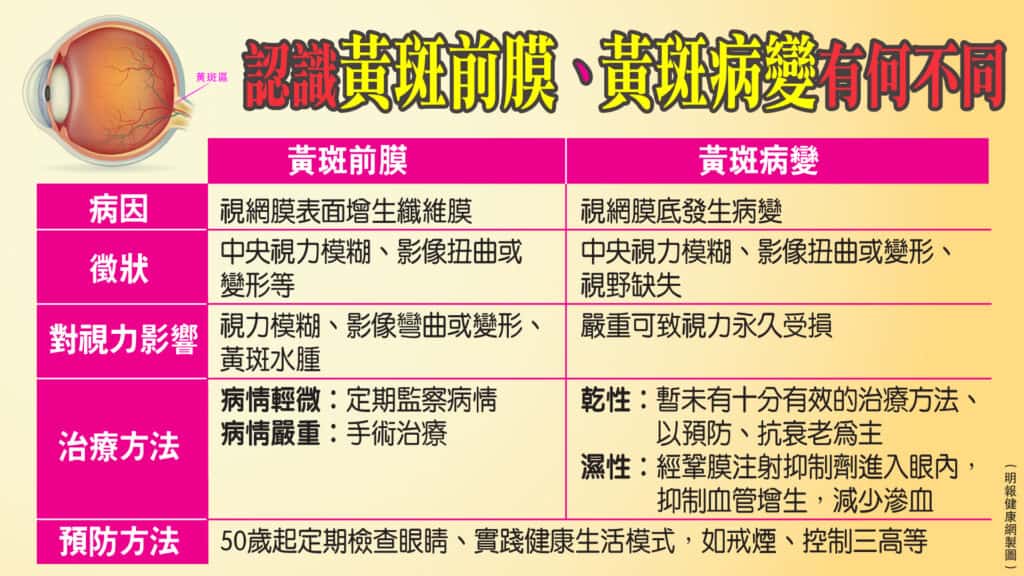 黃斑區常見眼疾：黃斑前膜、黃斑病變可致視力模糊、影像扭曲 勿與白內障混淆