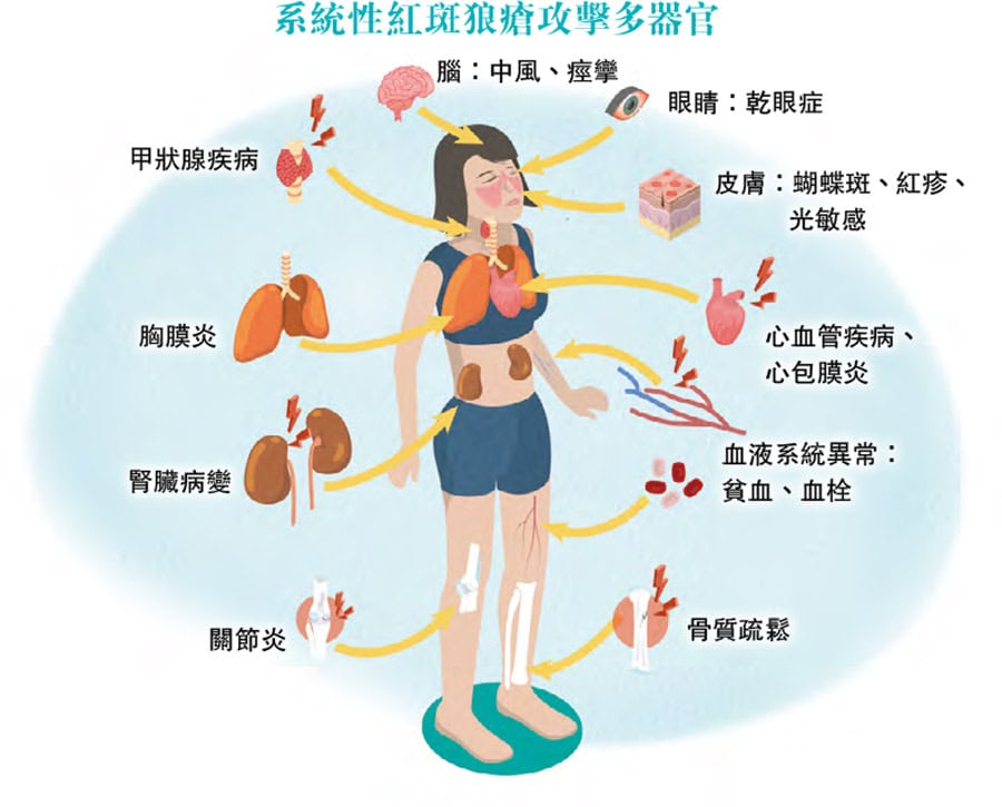 【紅斑狼瘡】長期服用類固醇副作用多 增骨枯、心臟病風險 生物製劑成效？