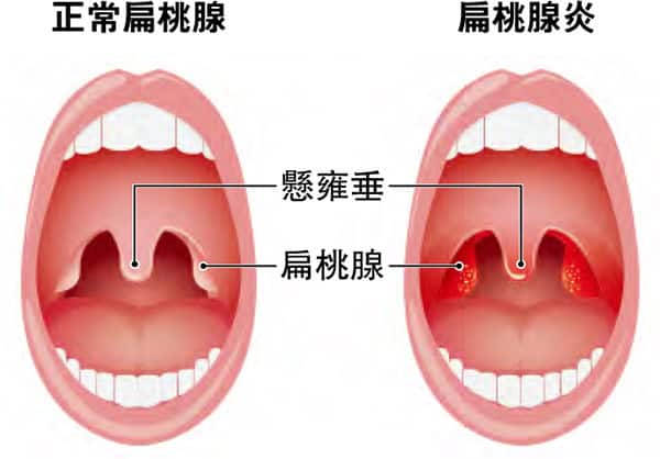 扁桃腺炎症狀發燒咽喉兩側痛 勿混淆傷風感冒 積膿嚴重可致心臟受損