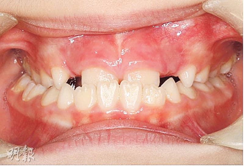 倒及牙加劇牙齒磨損 影響咀嚼、面部骨骼發育兼外觀 了解３種矯齒方法