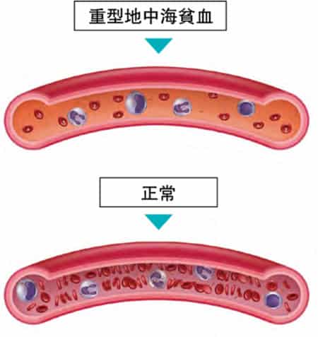 重型地中海貧血患者 長期輸血需「去鐵」 移植臍帶血可根治?