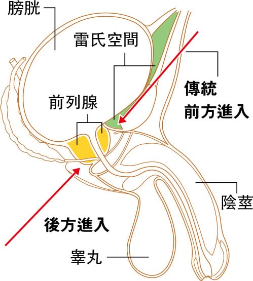 【前列腺癌】前列腺切除術後入式新技術 減術後尿失禁後遺症