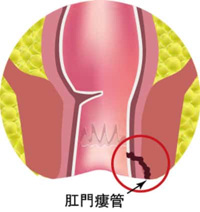 這不是痔瘡 肛門瘻管:肛門腺體發炎致膿瘡「谷」出不正常管道